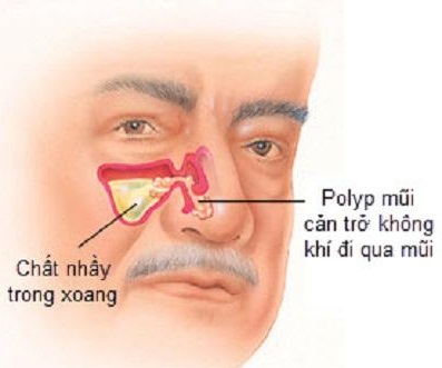 Polyp mũi