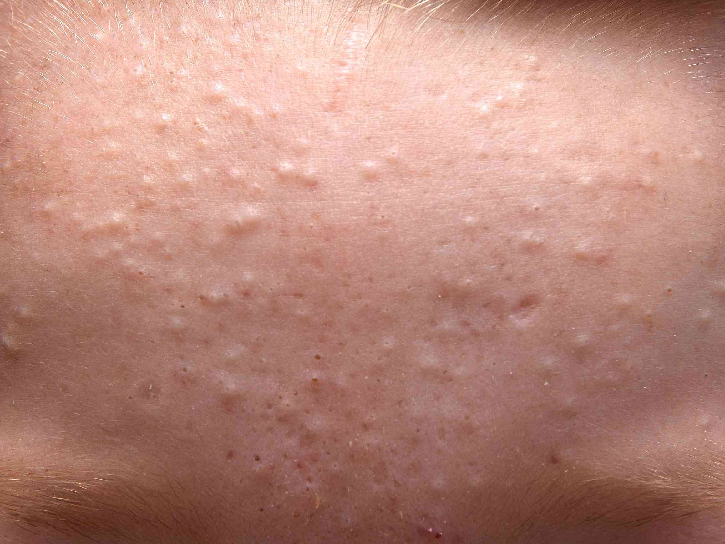 Cách nhận biết và điều trị mụn ẩn trên mặt