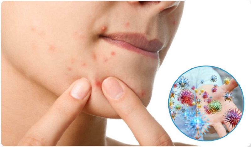 Không tự nặn mụn đầu trắng vì khiến mụn kích ứng hoặc nhiễm trùng, dẫn đến mụn bọc và sẹo