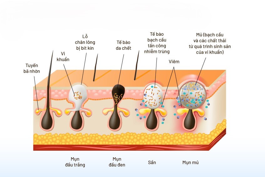 Sự gia tăng nồng độ Androgen sẽ kích thích quá trình sản xuất bã nhờn cùng với sự viêm nhiễm do vi khuẩn xâm nhập vào các nang lông gây mụn trứng cá.