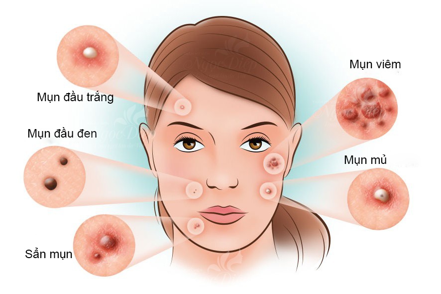 Mụn trứng cá do nhiều nguyên nhân gây ra 