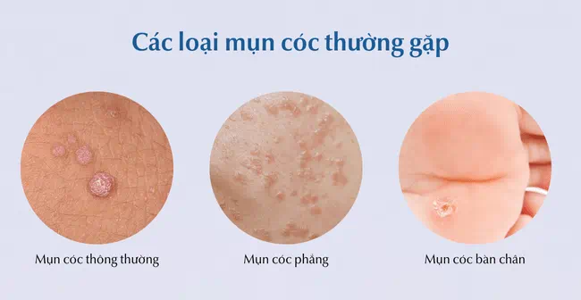 Các loại mụn cóc phổ biến