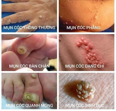 Mụn cóc thường gặp phát triển trên da do virut HPV