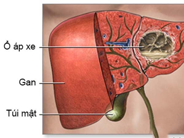 Áp xe gan là biến chứng của lỵ amip