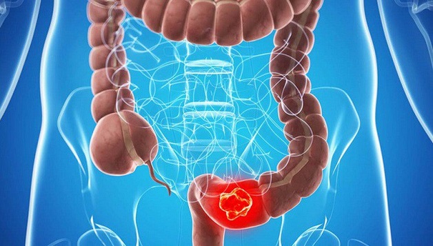 Tắc ruột là tình trạng tắc nghẽn bên trong ruột, các chất nghẹn ứ không thể di chuyển