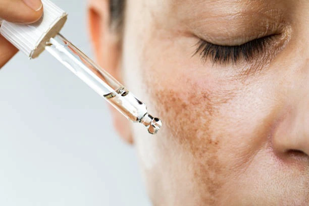 Điều trị nám da