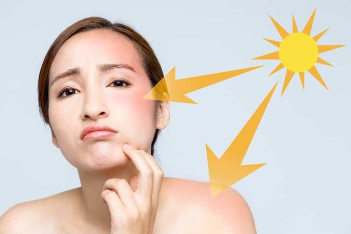 Nguyên nhân gây nám da và tàn nhang