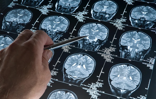 Chụp MRI Não