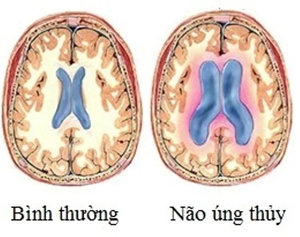 Não úng thủy gây suy giảm chức năng não bộ