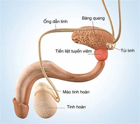 Viêm tuyến tiền liệt là tình trạng viêm nhiễm hoặc sưng viêm của tuyến tiền liệt