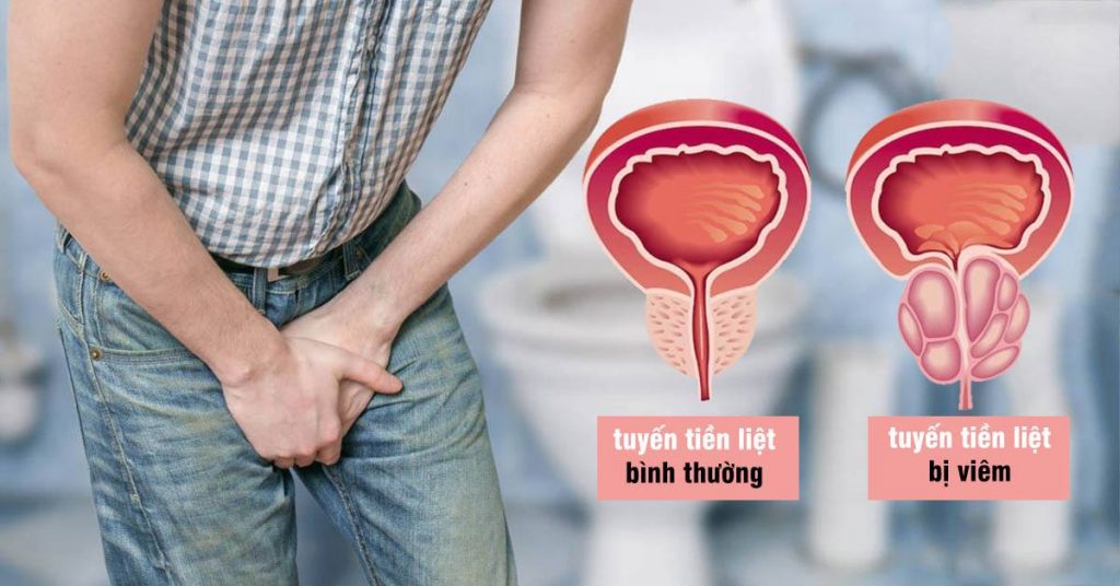 Tình trạng tổn thương tuyến tiền liệt gây các cơn đau