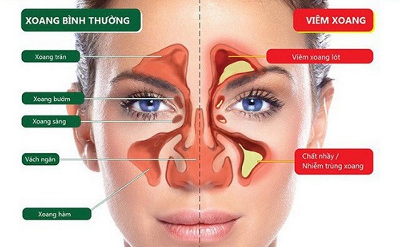 Viêm xoang là nguyên nhân gây ngạt mũi