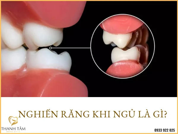 Nghiến răng là tình trạng bạn cắn chặt hai hàm khi ngủ