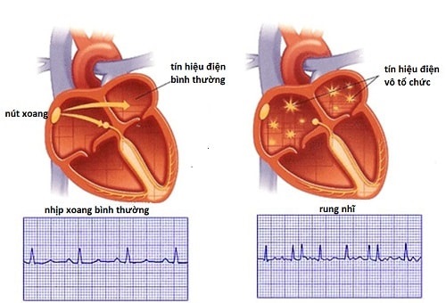 Nhịp đập, nhịp bỏ là dấu hiệu điển hình của ngoại tâm thu