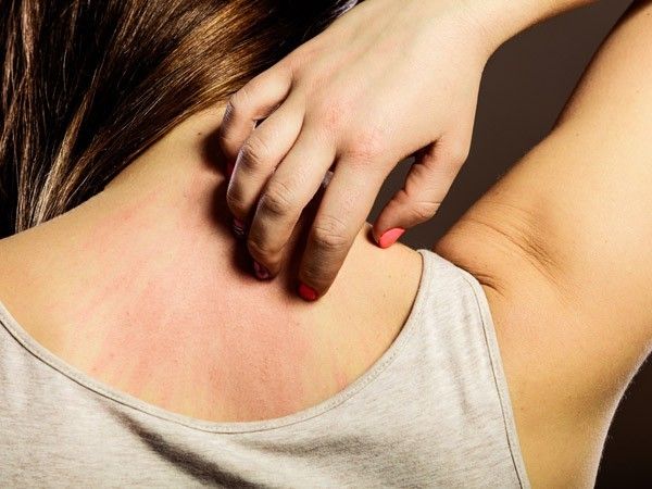 Dị ứng với chăn ga hoặc môi trường ngủ có thể gây ngứa toàn thân vào ban đêm