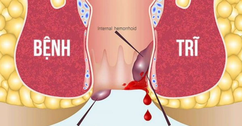 Bệnh trĩ là tình trạng những tĩnh mạch bị sưng ở trực tràng hoặc hậu môn, có thể gây nóng và ngứa