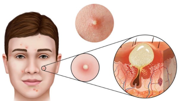 Tắc nghẽn nang lông gây mụn trứng cá