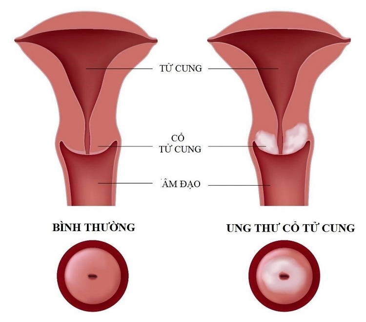 Hiểu rõ về ung thư cổ tử cung giúp phụ nữ chủ động phòng ngừa