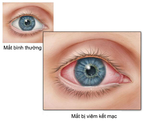 Viêm kết mạc dị ứng là bệnh lý có thể gặp ở mọi đối tượng