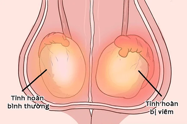 Viêm tinh hoàn là tình trạng sưng đau ở 1 hoặc cả 2 tinh hoàn trong bìu