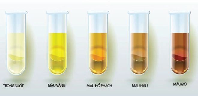 Việc chẩn đoán sớm giúp xác định chính xác nguyên nhân gây hiện tượng nước tiểu màu hồng 