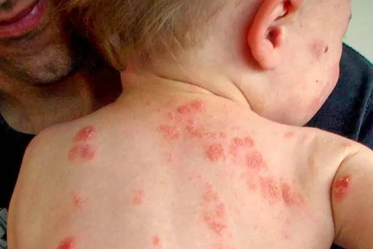 Việc vệ sinh và chăm sóc vết loét đúng cách giúp ngăn ngừa nhiễm trùng thứ phát