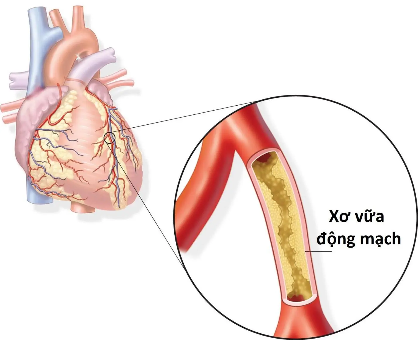 Xơ vữa động mạch là nguyên nhân chính gây ra nhồi máu cơ tim