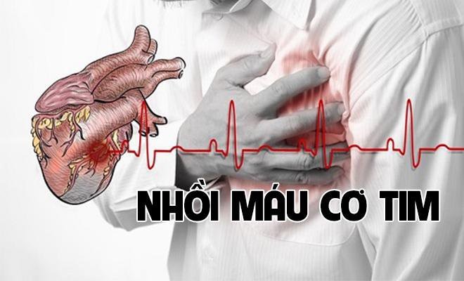 Nhồi máu cơ tim là gì?