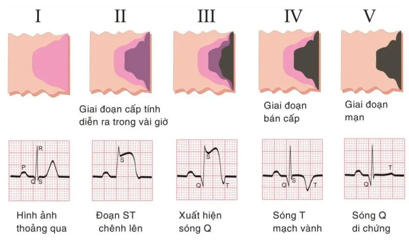 Điện tâm đồ là công cụ quan trọng nhất để chẩn đoán nhồi máu cơ tim