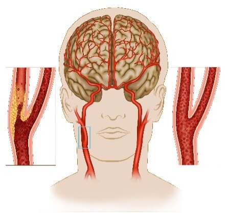 Xơ vữa động mạch cảnh gây nhồi máu não