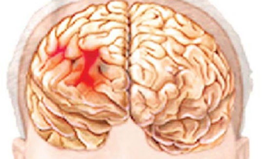 Hình ảnh nhũn não