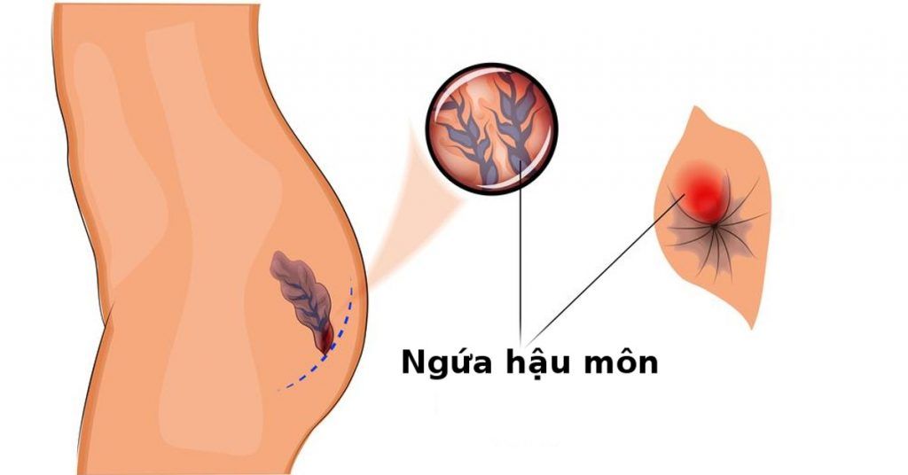 Việc thăm khám sớm giúp ngăn ngừa các biến chứng nguy hiểm từ rò hậu môn và trĩ