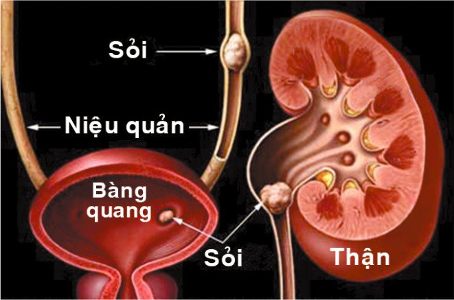 Có nhiều nguyên nhân dẫn đến sỏi niệu quản.