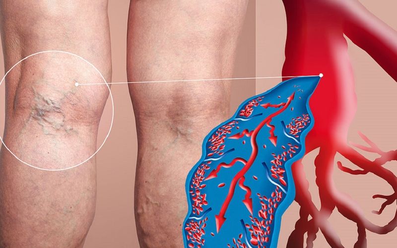 Hình minh họa tổng quan về bệnh giãn tĩnh mạch chân