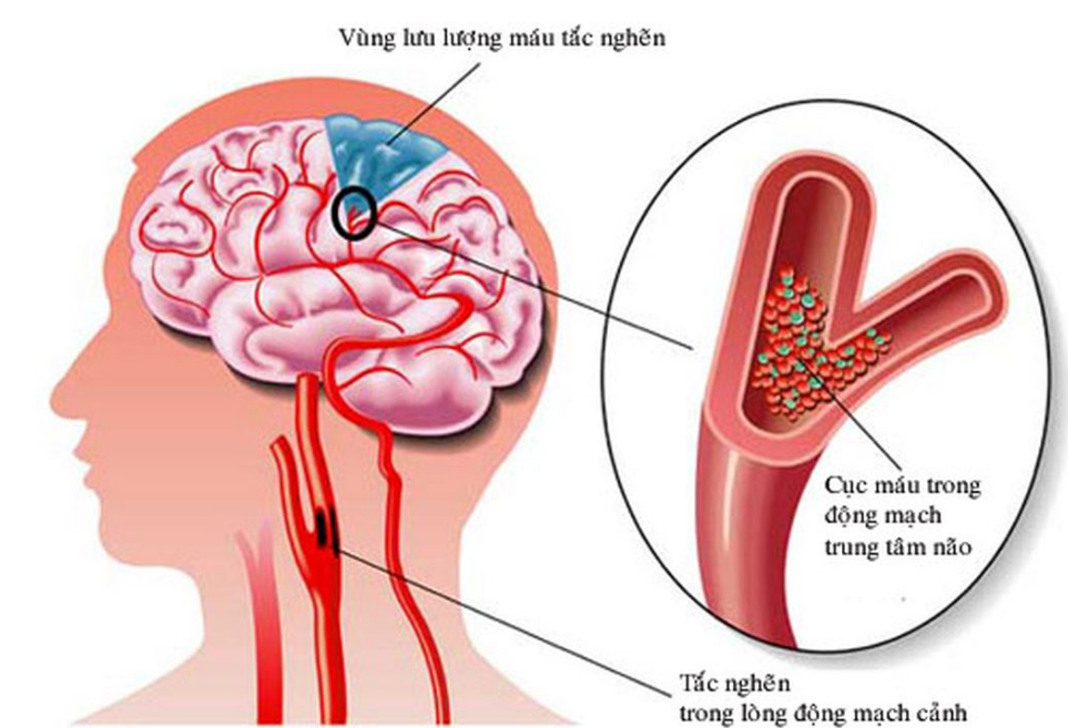 Cục máu đông và tắc nghẽn trong lòng động mạch là một trong những nguyên nhân gây thiểu năng tuần hoàn não