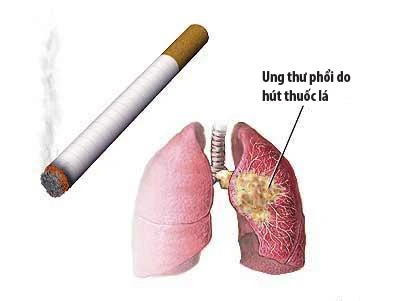 Khói thuốc lá là tác nhân hàng đầu gây đột biến tế bào dẫn đến ung thư phổi