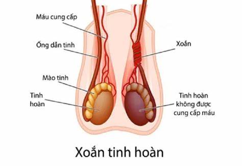 Xoắn tinh hoàn