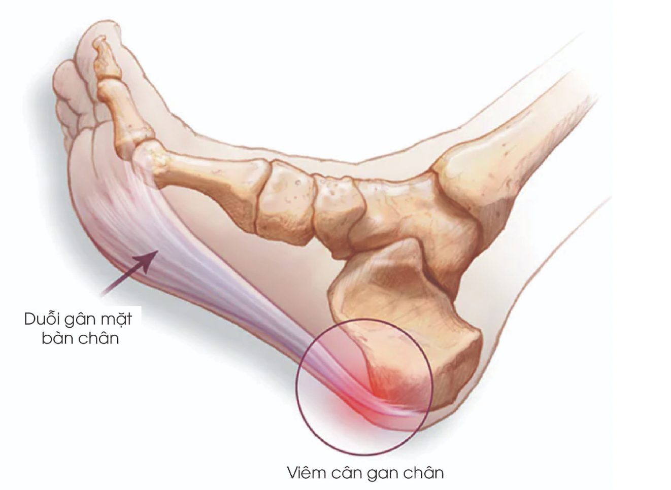 Viêm cân gan chân là một trong những nguyên nhân chính gây đau gót chân