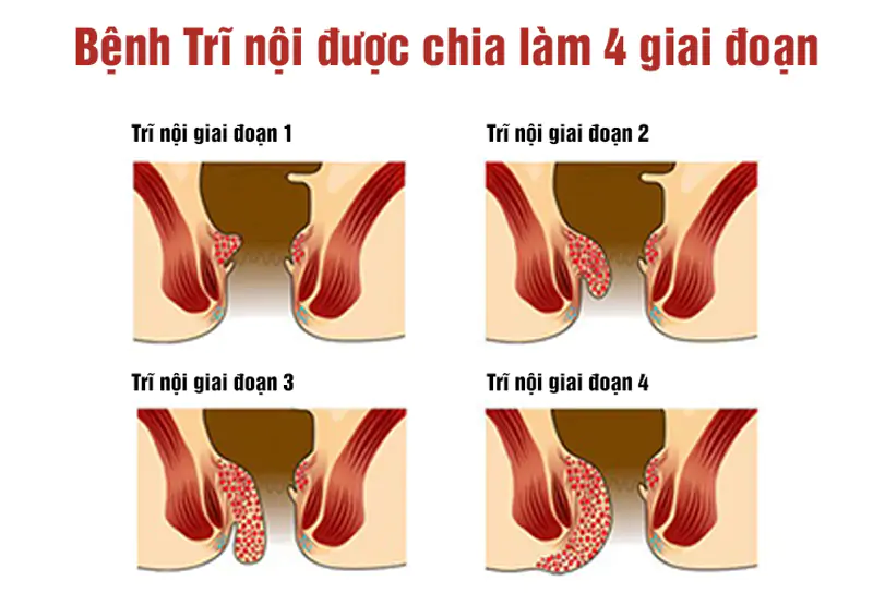 Trĩ nội được chia làm 4 cấp độ