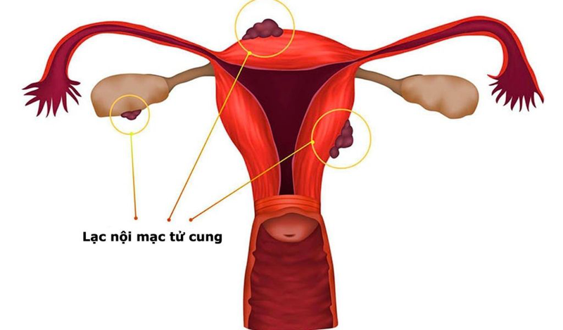 Bệnh lý lạc nội mạc tử cung