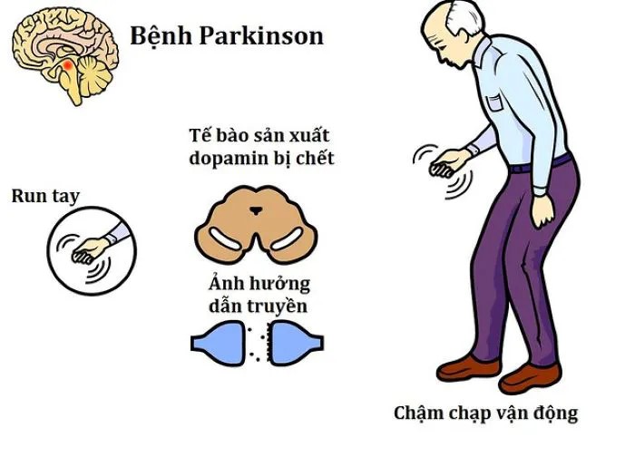 Bệnh Parkinson là một rối loạn thoái hóa não ảnh hưởng đến hệ thống vận động.