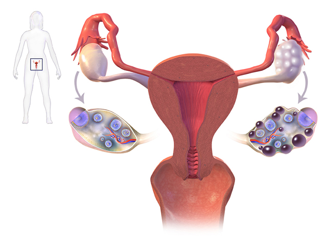 Hội chứng buồng trứng đa nang (PCOS)