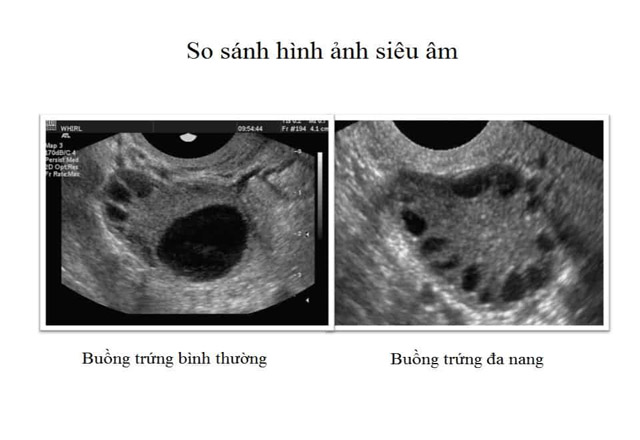 Hình ảnh buồng trứng đa nang trên siêu âm cho phép bác sĩ chẩn đoán bệnh chính xác