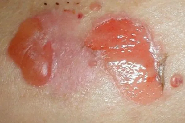 Hình ảnh tổn thương da đóng vảy tiết đặc trưng ở bệnh nhân Pemphigus vảy lá