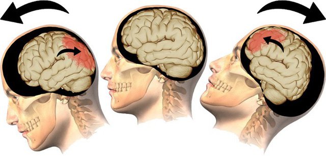 VI. Cách phòng ngừa chấn thương sọ não