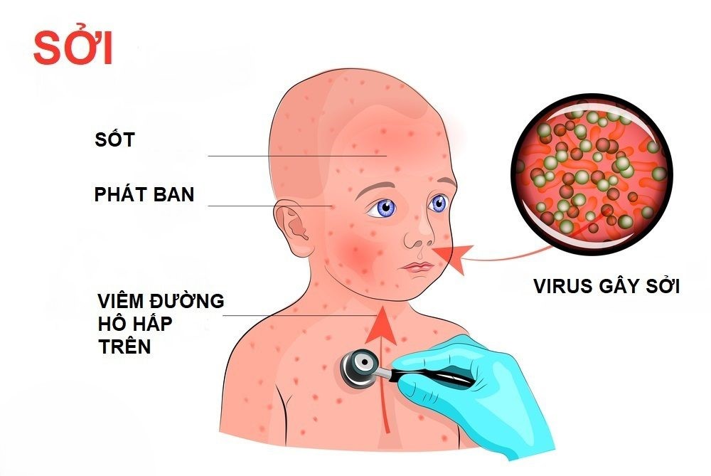 Với bệnh sốt phát ban, đa số các trường hợp nhiễm bệnh là do có nguyên nhân là nhiễm virus thông thường.