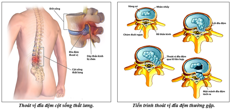 Hình thái các khối thoát vị đĩa đệm.