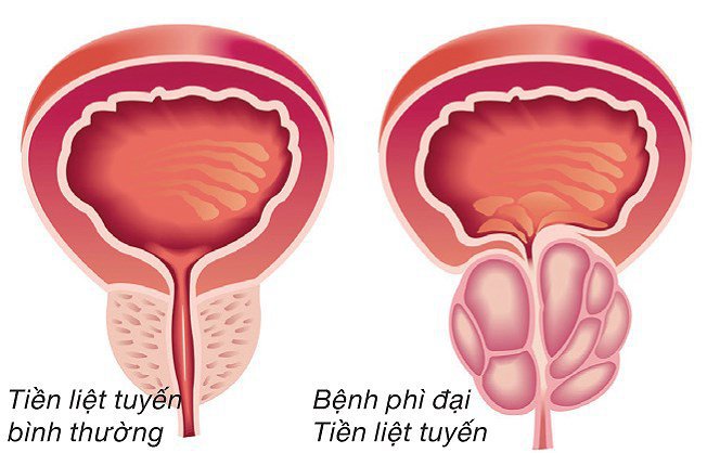 Phì đại tiền tuyến liệt