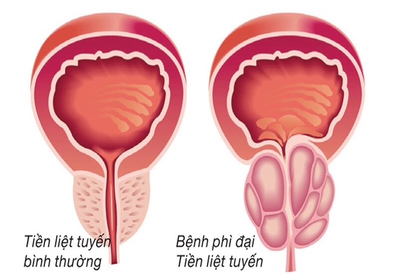 Phì đại tiền liệt tuyến là do quá trình tăng sản sinh lý của nhu mô tuyến tiền liệt ở nam giới