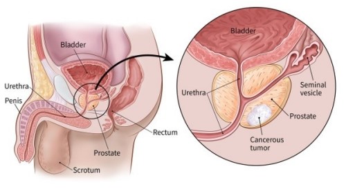 Phì đại tuyến tiền liệt. 